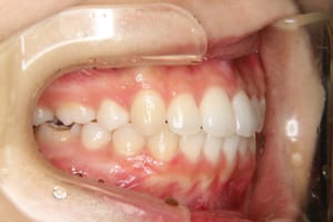 右下第一大臼歯はCR充填不良のためやり直し予定です。